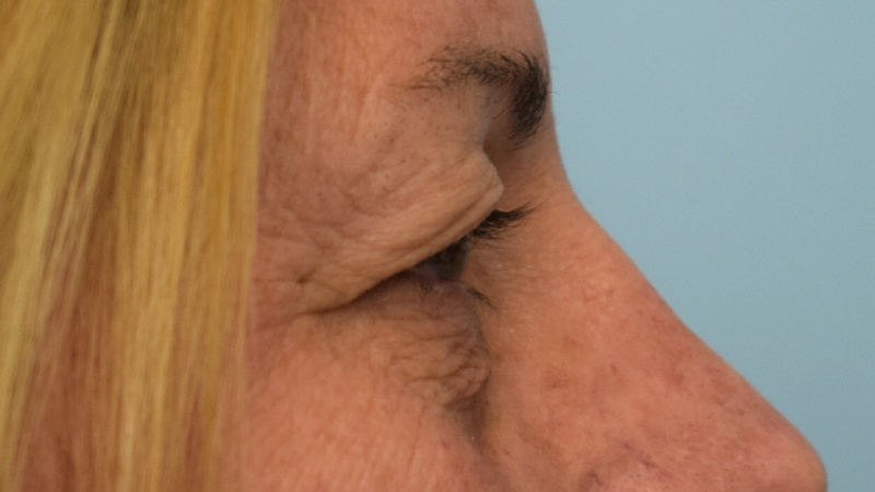 Blepharoplasty Before & After Image