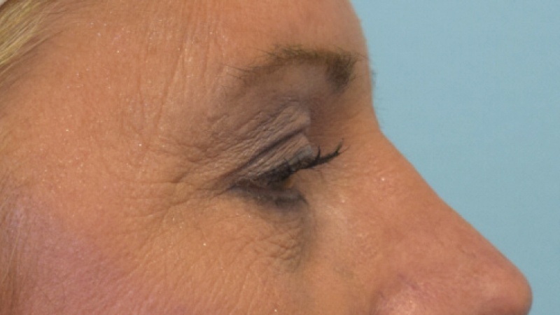 Blepharoplasty Before & After Image