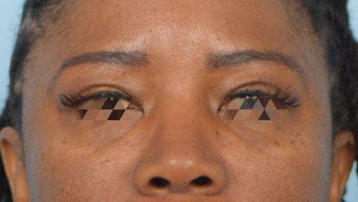 Blepharoplasty Before & After Image