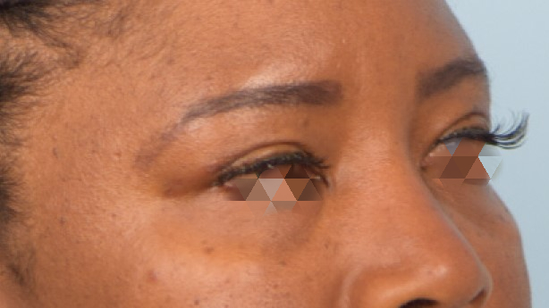 Blepharoplasty Before & After Image