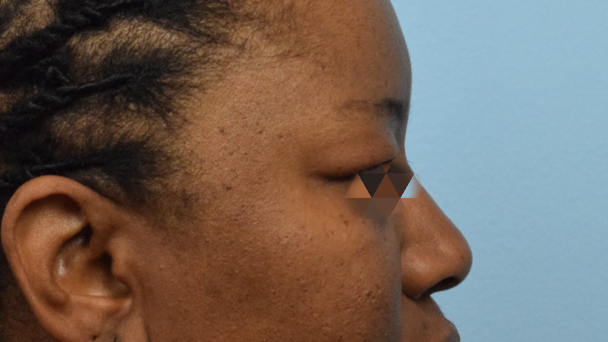 Blepharoplasty Before & After Image