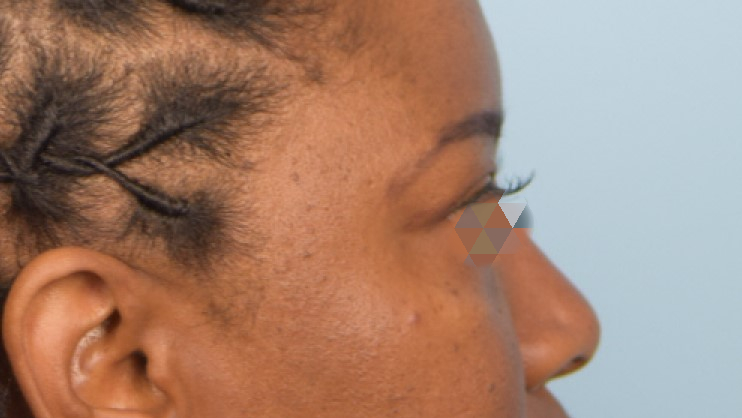 Blepharoplasty Before & After Image