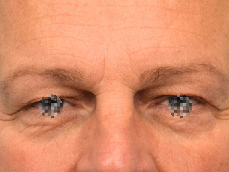 Blepharoplasty Before & After Image