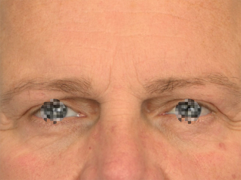 Blepharoplasty Before & After Image