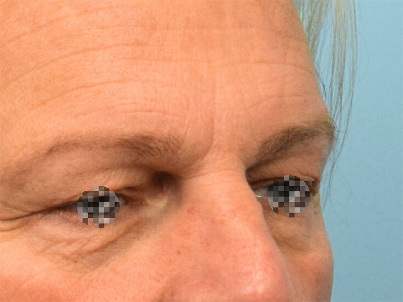 Blepharoplasty Before & After Image