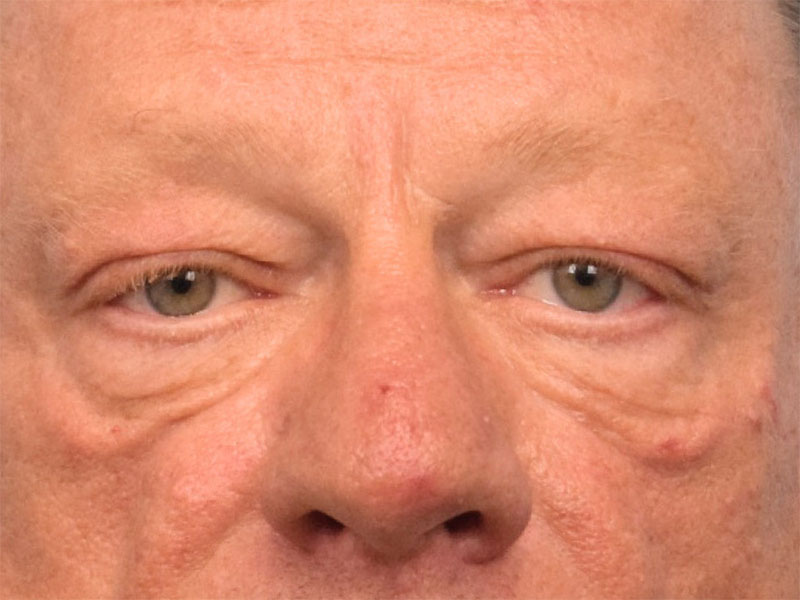 Blepharoplasty Before & After Image