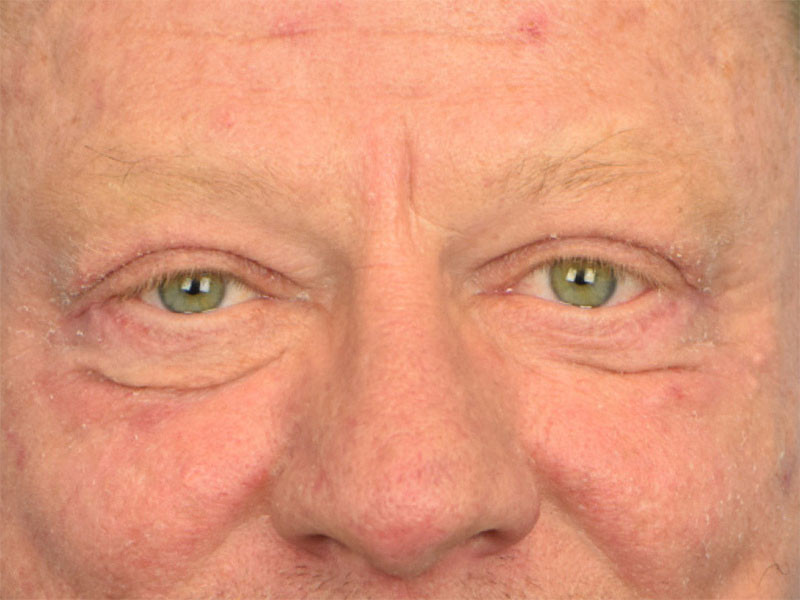 Blepharoplasty Before & After Image