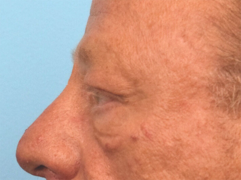 Blepharoplasty Before & After Image