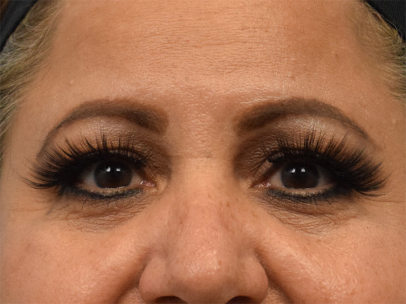 Blepharoplasty Before & After Image