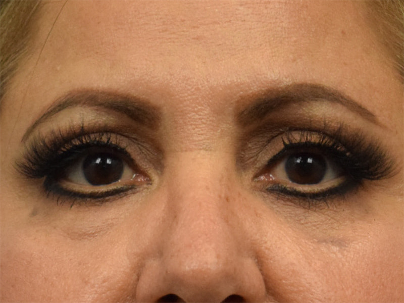 Blepharoplasty Before & After Image