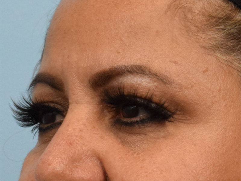 Blepharoplasty Before & After Image