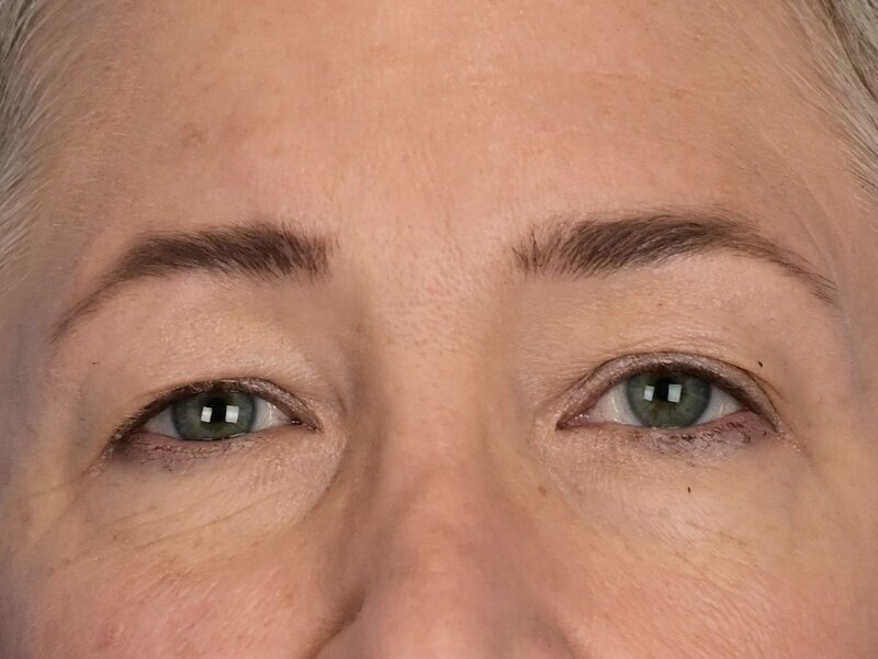 Blepharoplasty Before & After Image