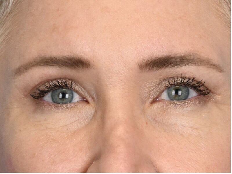 Blepharoplasty Before & After Image