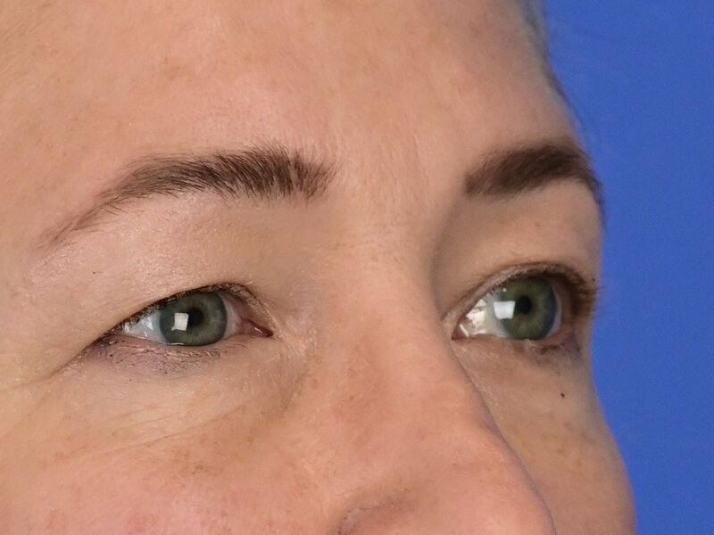 Blepharoplasty Before & After Image
