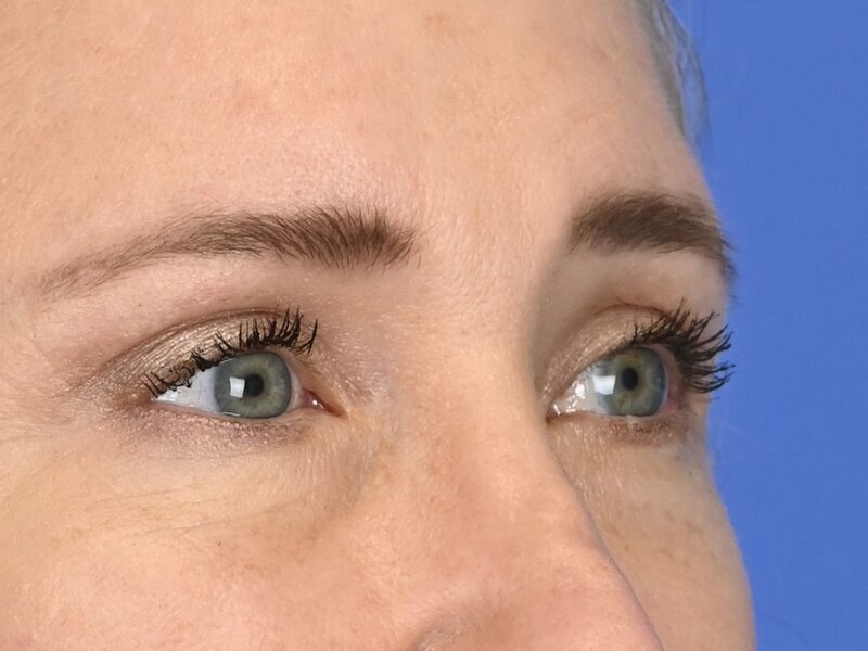 Blepharoplasty Before & After Image