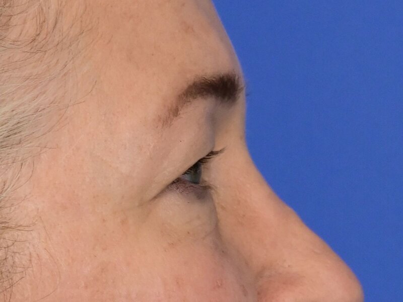 Blepharoplasty Before & After Image