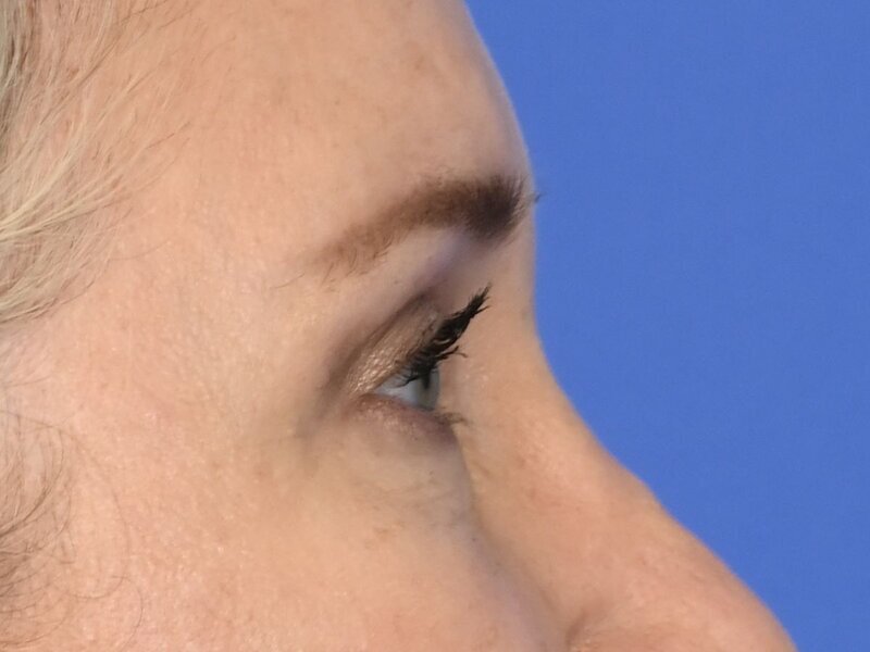 Blepharoplasty Before & After Image