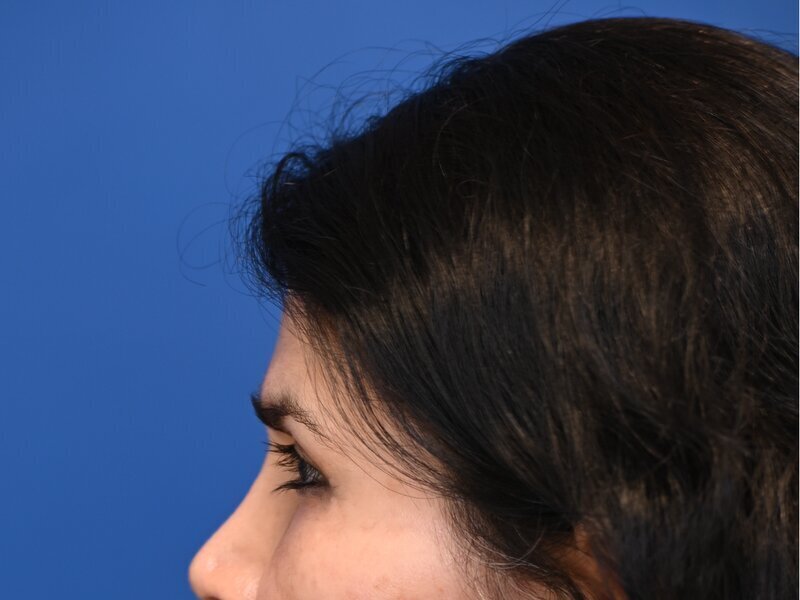 Blepharoplasty Before & After Image