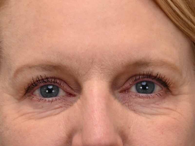 Blepharoplasty Before & After Image