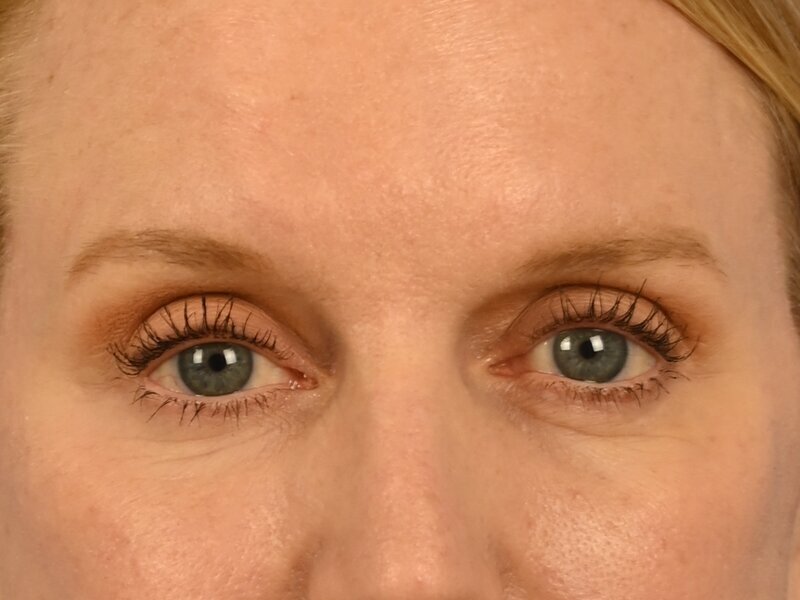 Blepharoplasty Before & After Image