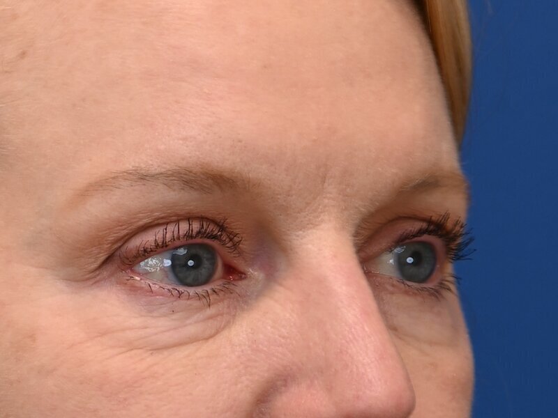 Blepharoplasty Before & After Image