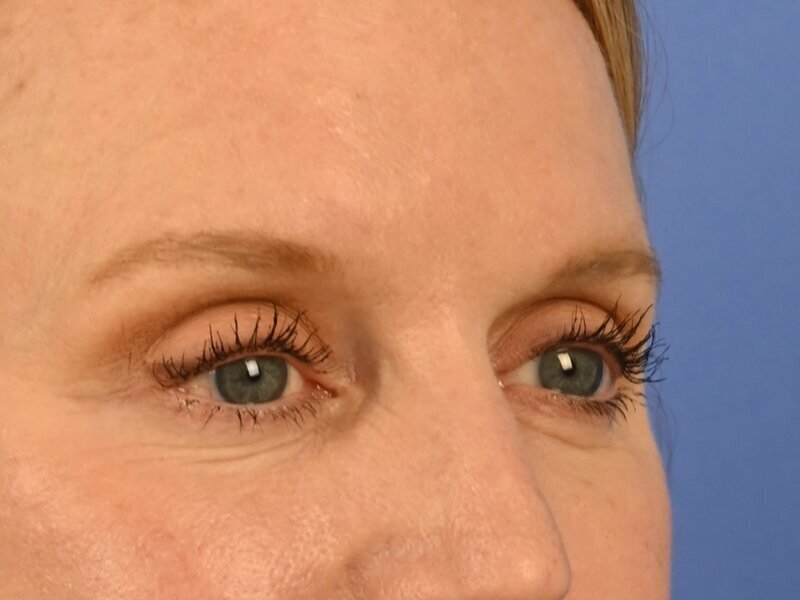 Blepharoplasty Before & After Image