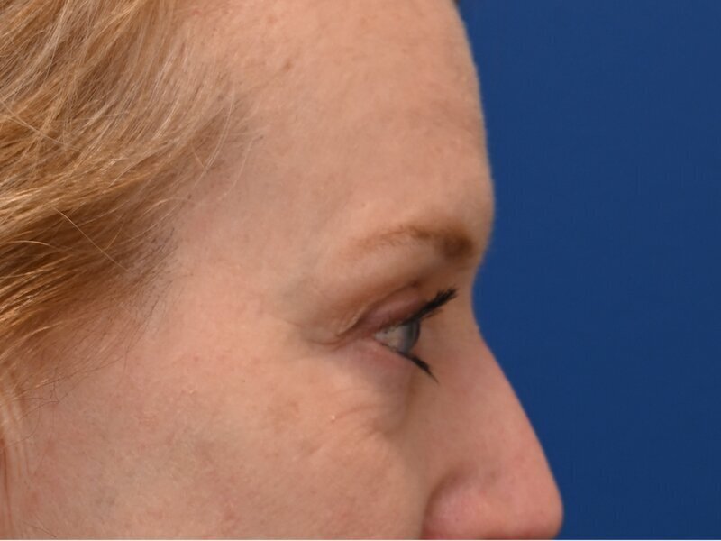 Blepharoplasty Before & After Image