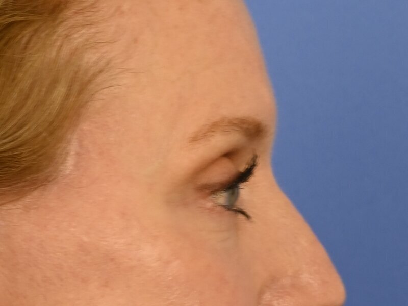 Blepharoplasty Before & After Image