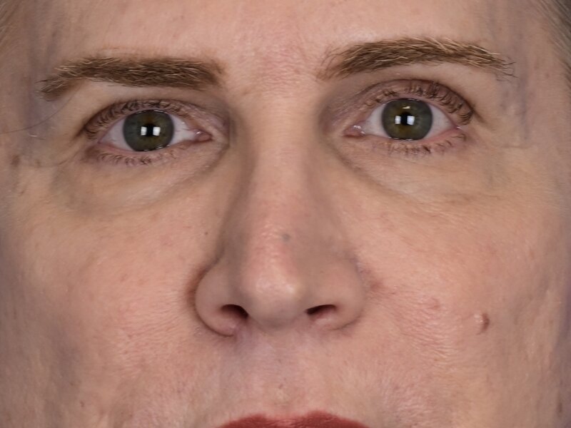 Blepharoplasty Before & After Image