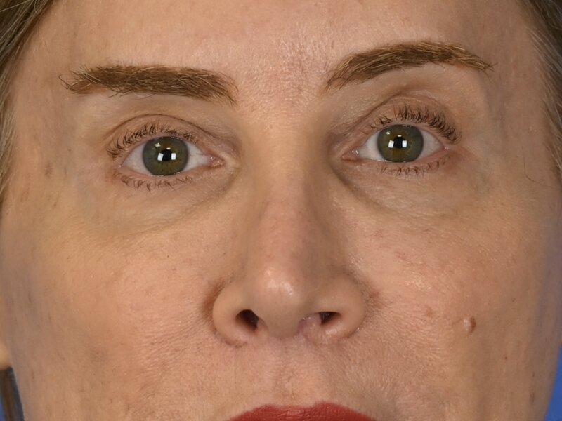 Blepharoplasty Before & After Image