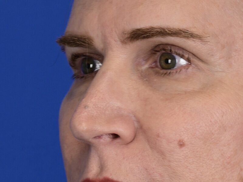 Blepharoplasty Before & After Image