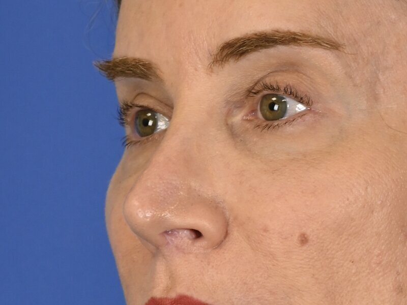 Blepharoplasty Before & After Image