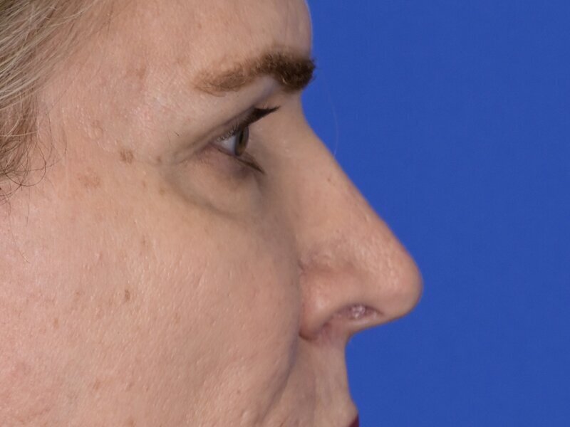 Blepharoplasty Before & After Image