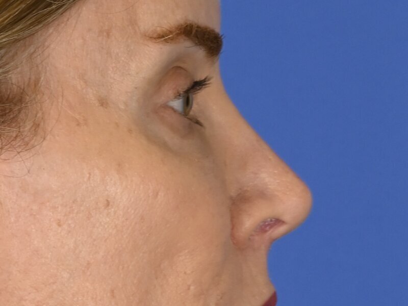 Blepharoplasty Before & After Image