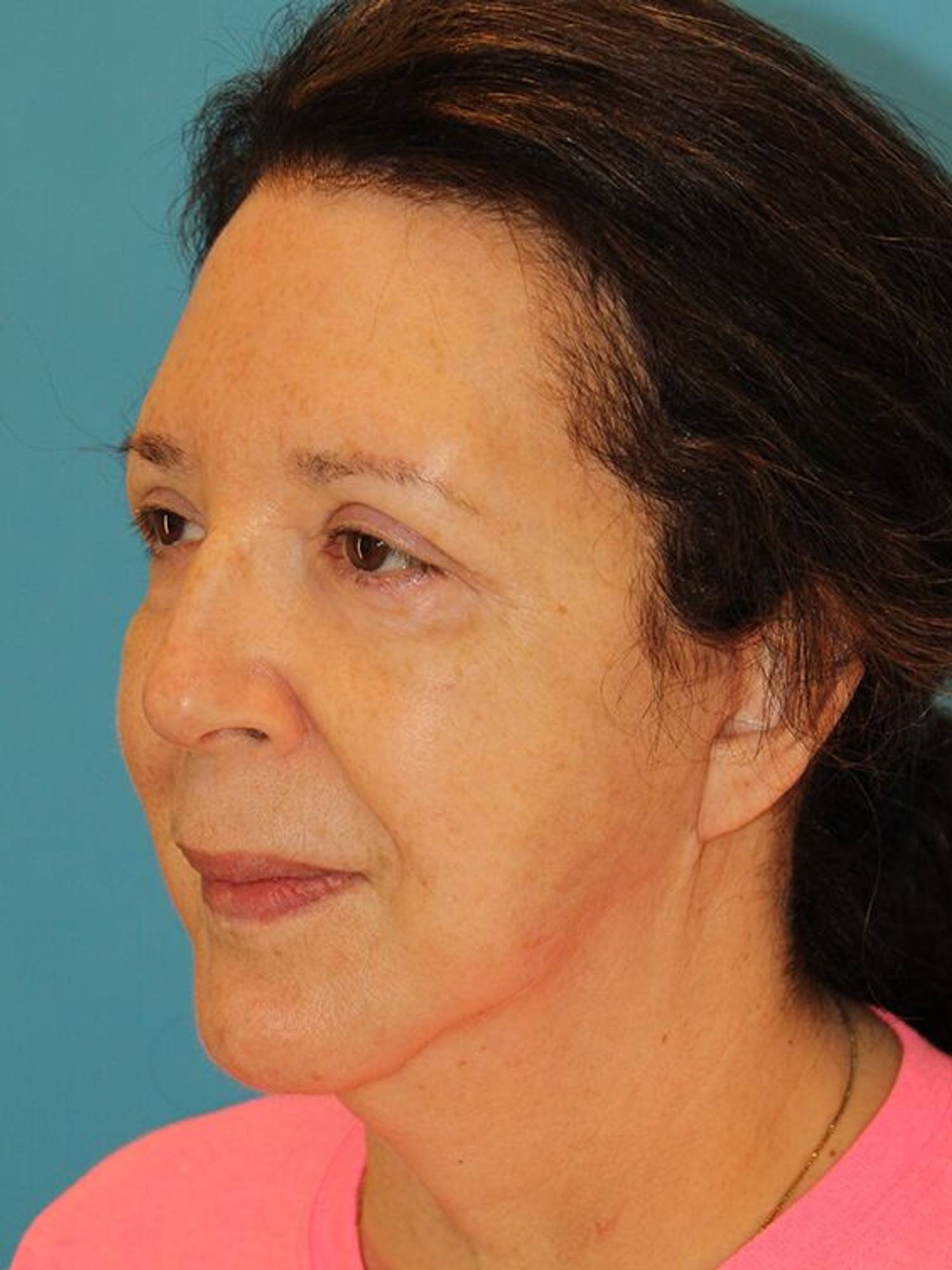 Face & Neck Lift Before & After Image