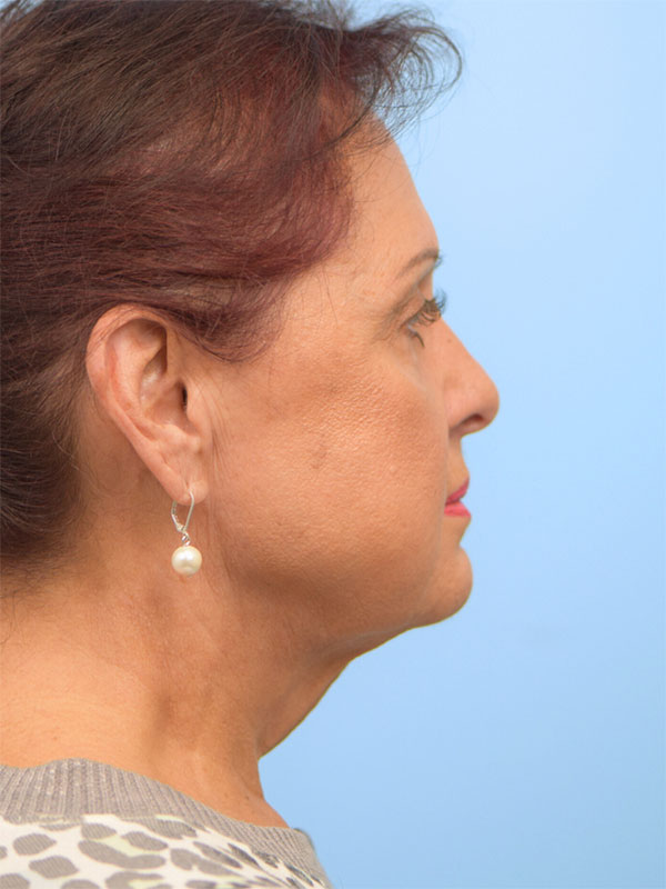 Face & Neck Lift Before & After Image