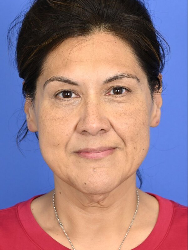 Face & Neck Lift Before & After Image
