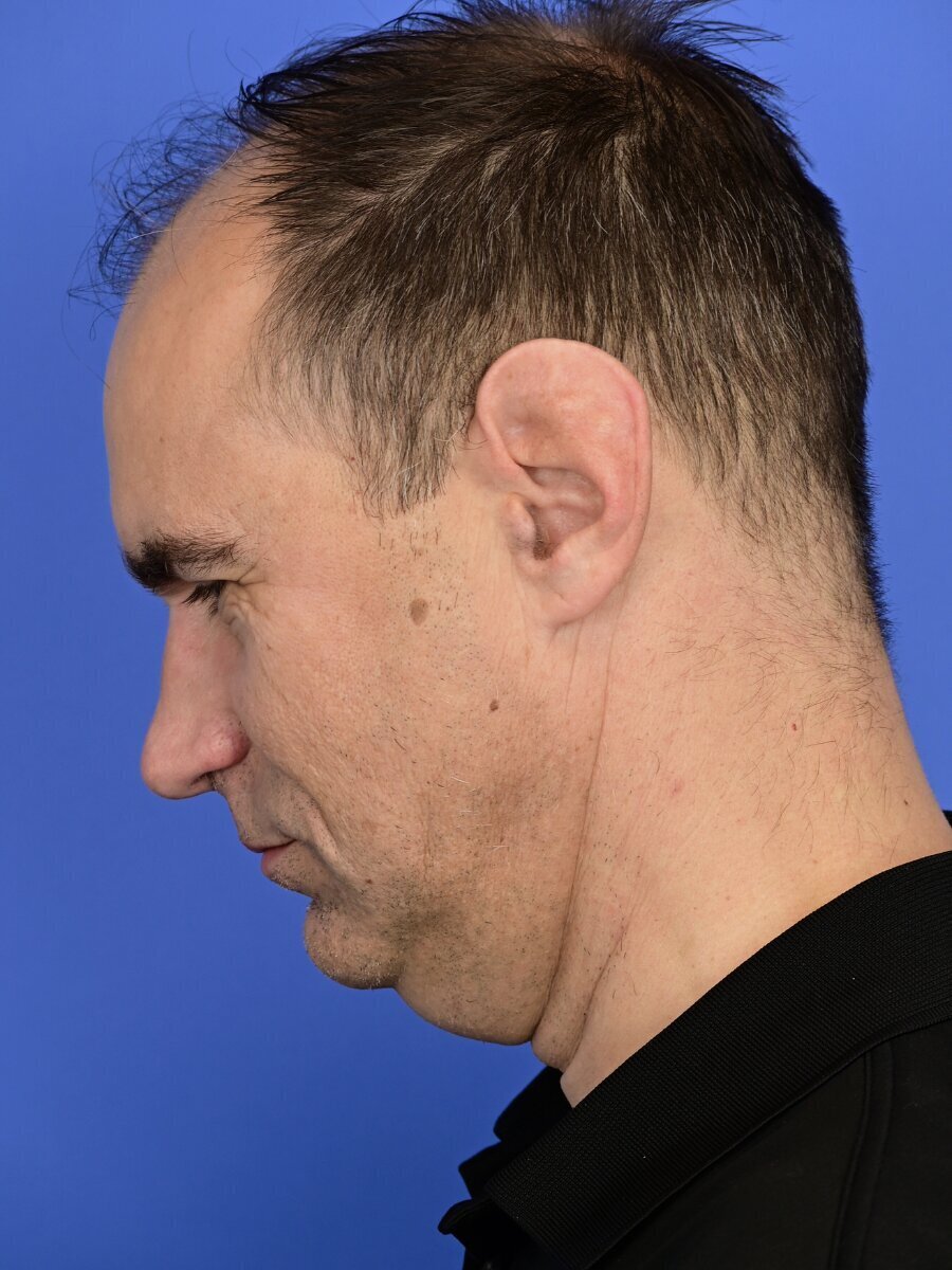 Face & Neck Lift Before & After Image