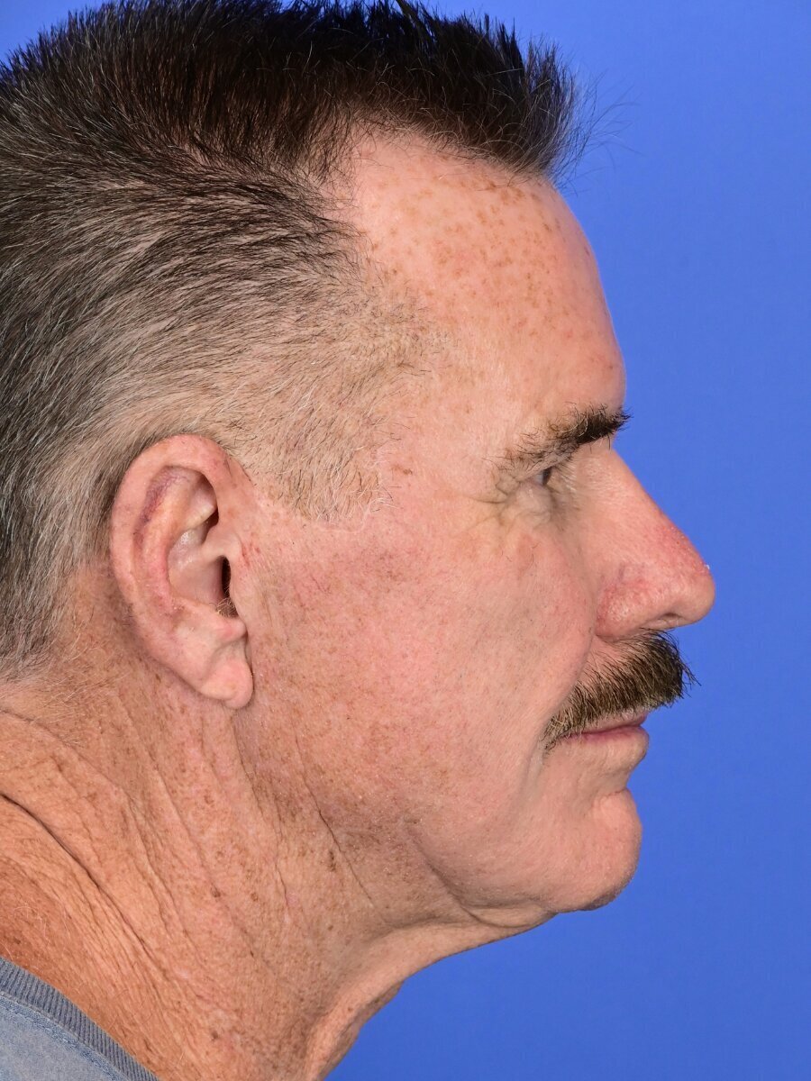 Face & Neck Lift Before & After Image