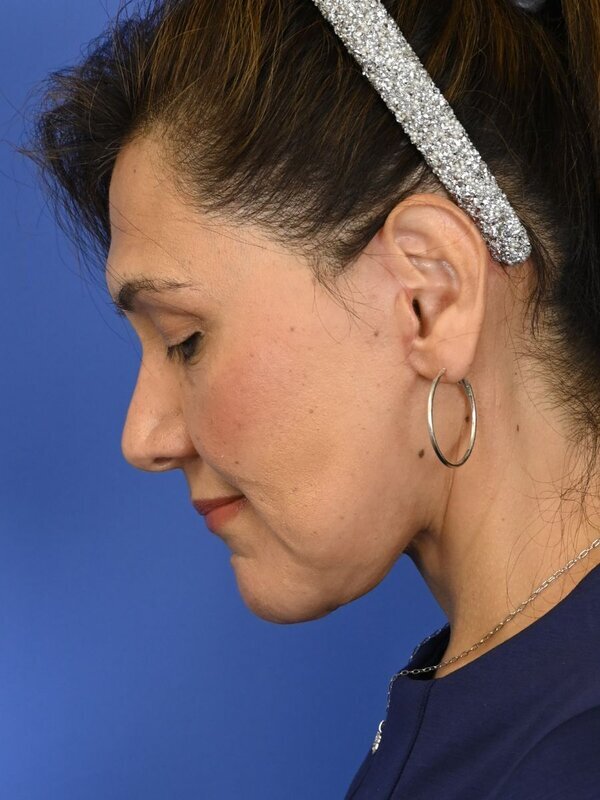 Face & Neck Lift Before & After Image