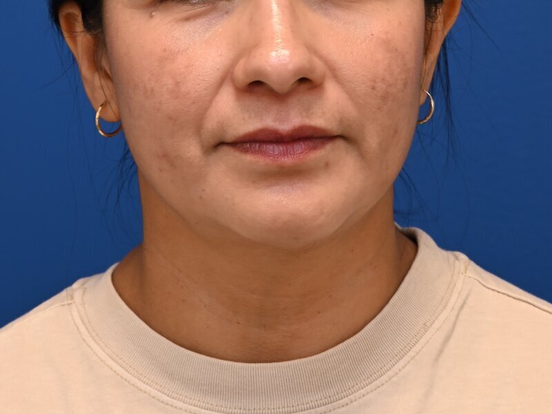 Face and neck lift Before & After Image