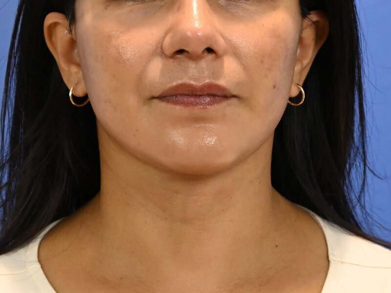 Face and neck lift Before & After Image