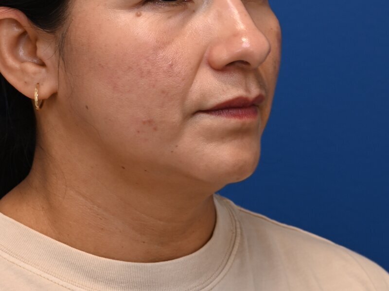 Face and neck lift Before & After Image