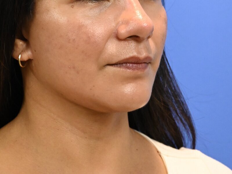 Face and neck lift Before & After Image