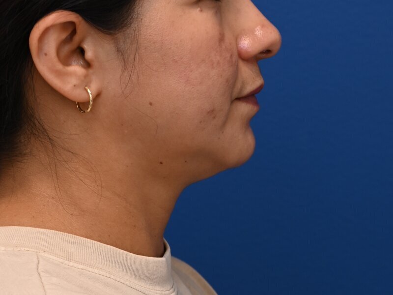 Face & Neck Lift Before & After Image