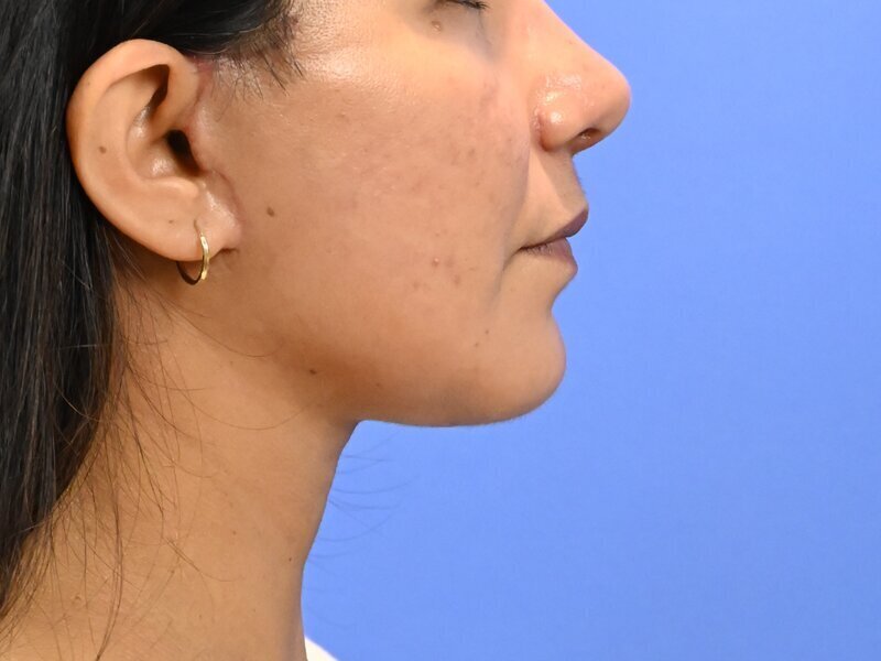 Face & Neck Lift Before & After Image