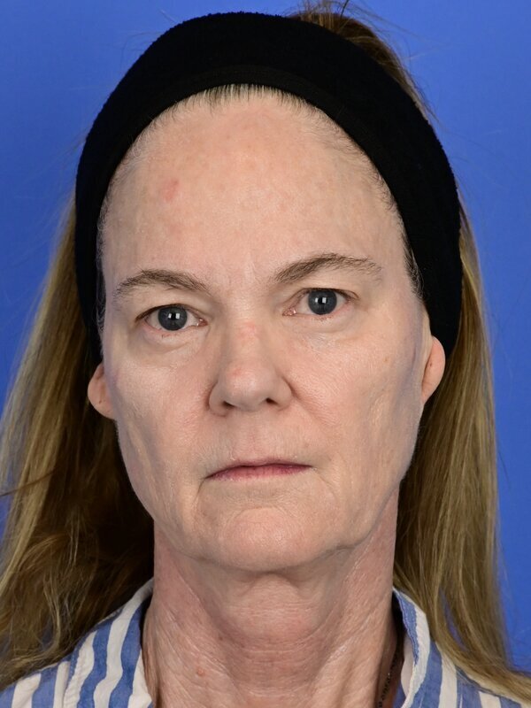 Face and neck lift Before & After Image