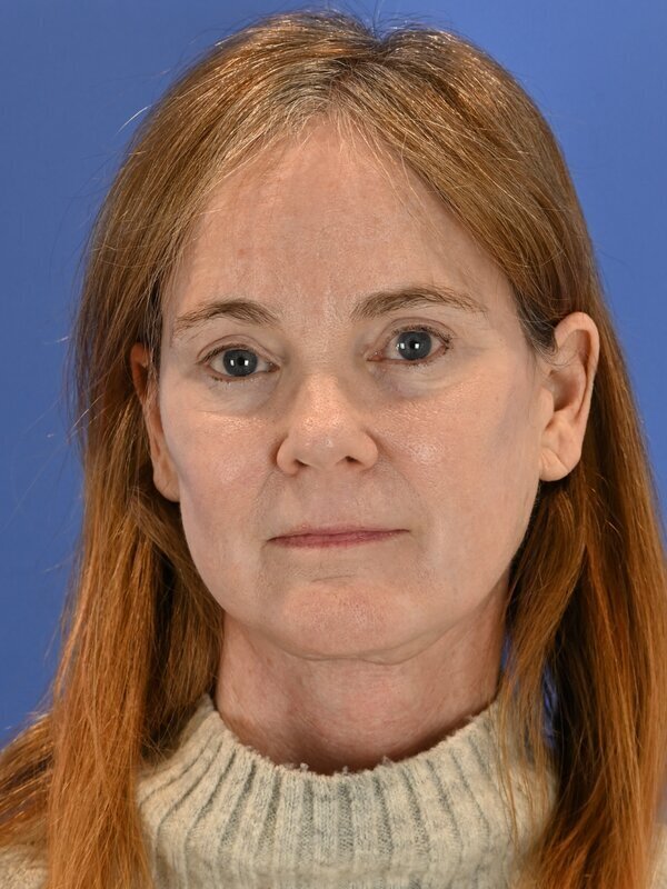 Face and neck lift Before & After Image