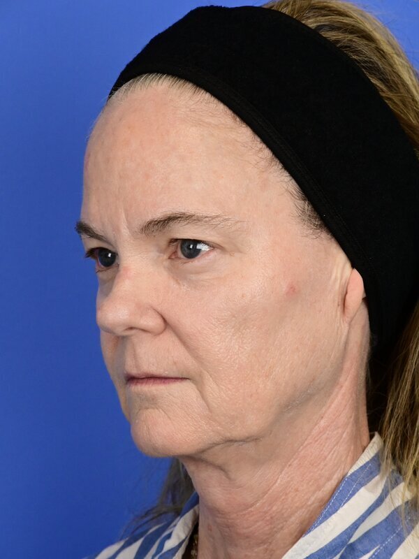 Face and neck lift Before & After Image