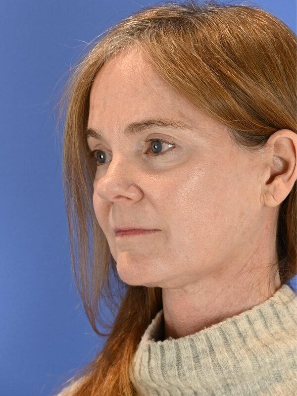 Face and neck lift Before & After Image